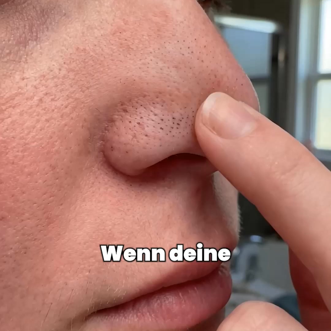 Tschüss Mitesser, hallo klare Haut ✨