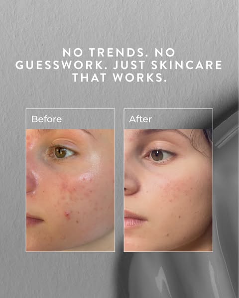 Clear skin in just 90 days