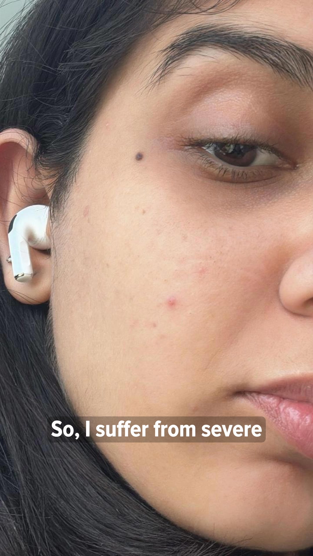 The Ultimate AM:PM Duo for Acne-Prone Skin