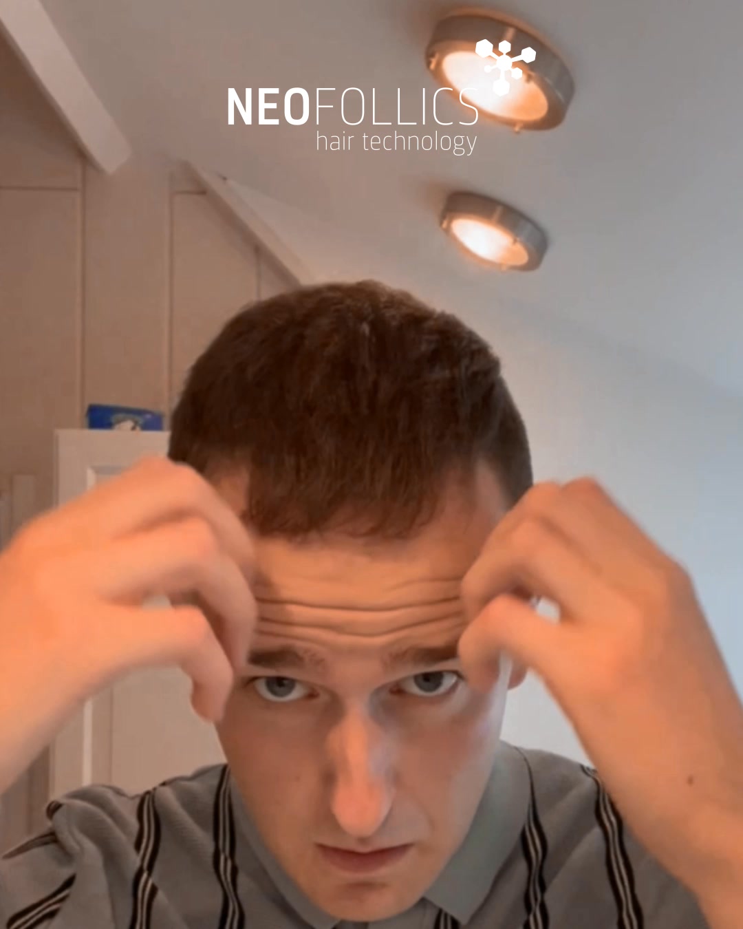 Last van haaruitval?