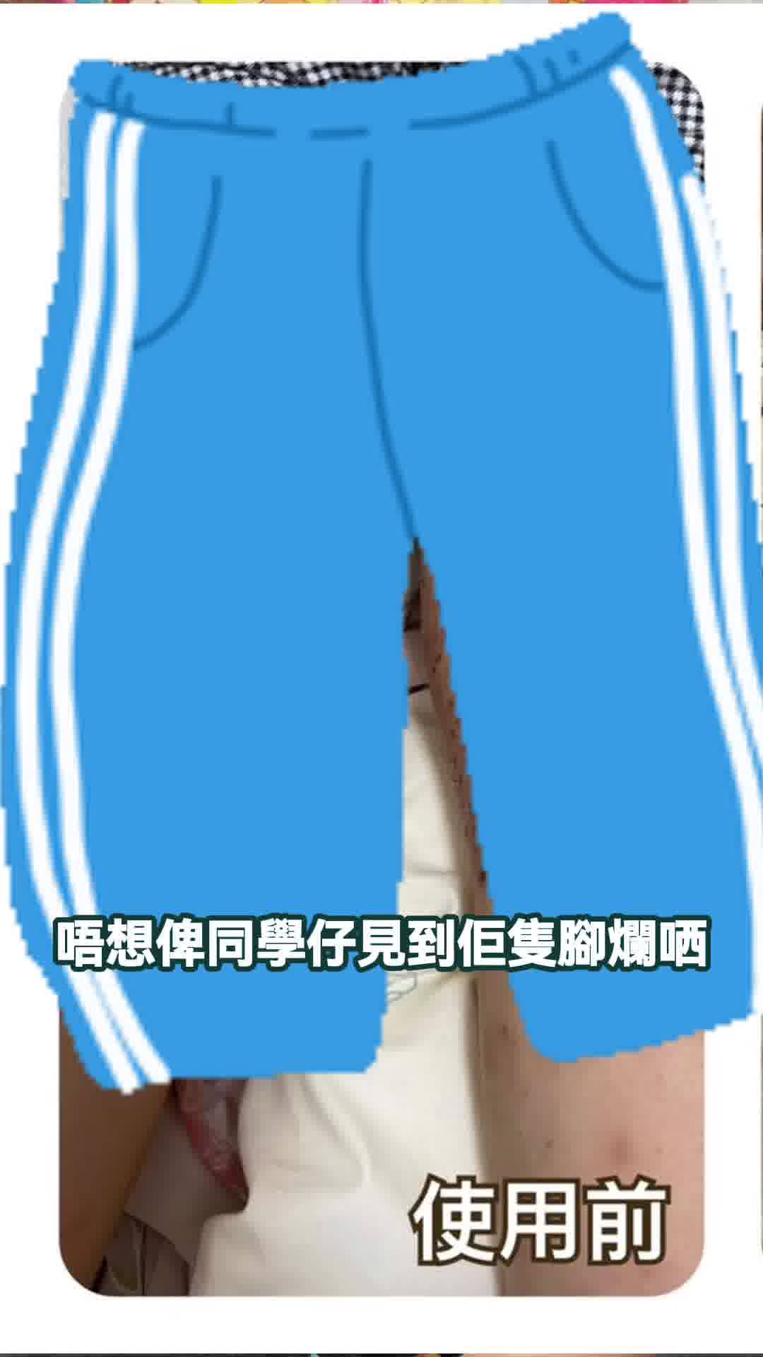 兒童濕疹｜8歲女孩濕疹爛腳自卑 靠CUBED護膚品好轉