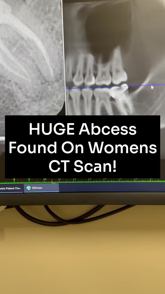 Find a dentist that does cone beam ct scans that show the jaws and airway.

Need my dentist directory? Comment "directory" below. 

#conebeamctscan #ctscan #dentalscan #toothabcess #toothache #rootcanal #holisticdentist #biologicaldentist #womenshealth #jawclicks 

@totalcaredentalutah