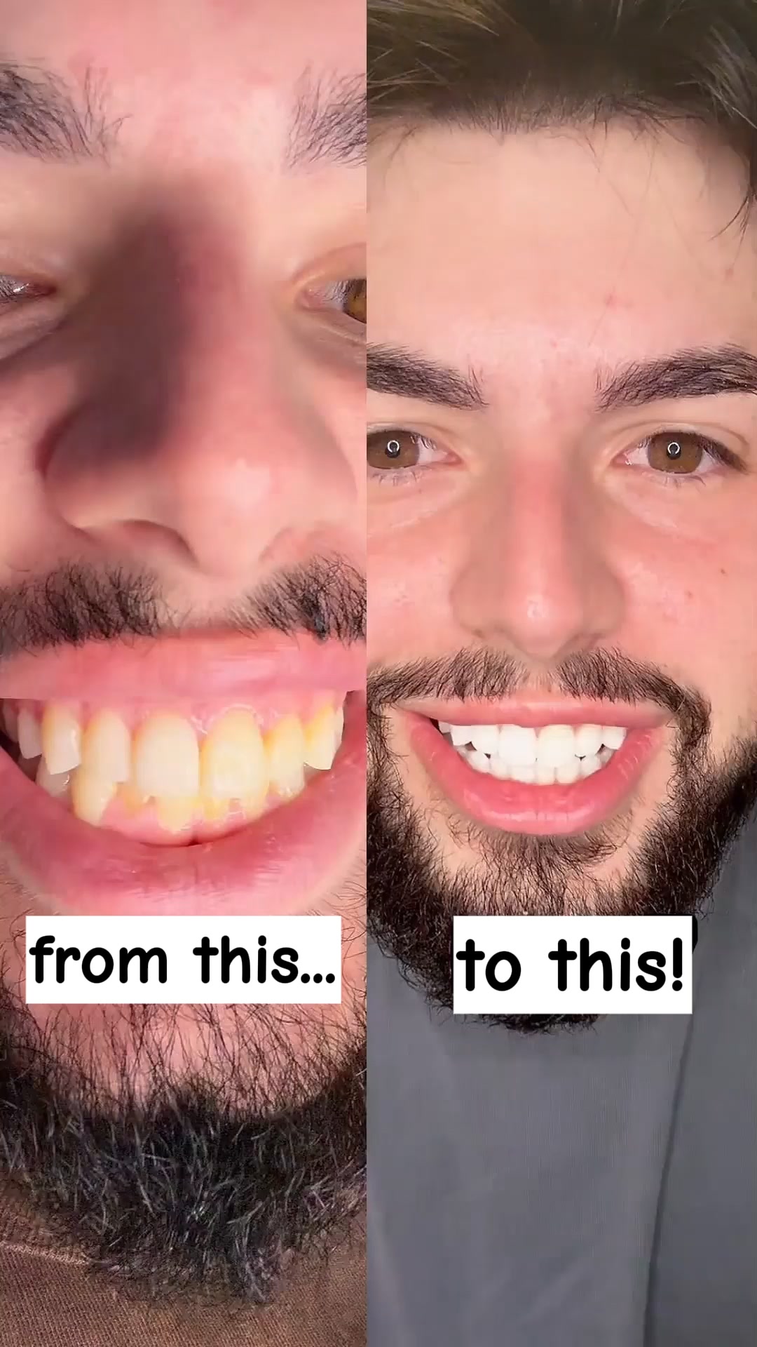 Dentist-Quality Whitening