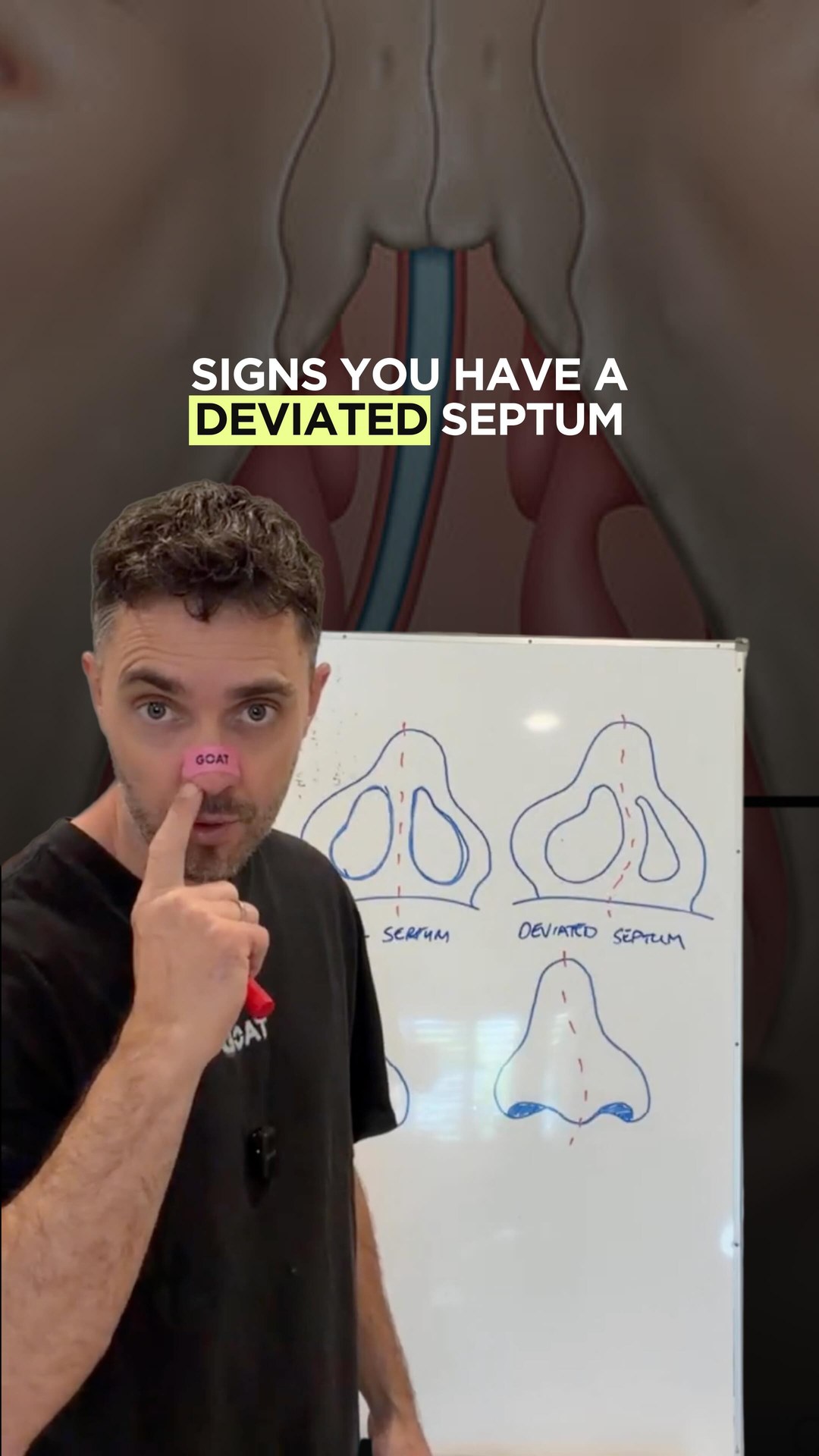 If you have a dodgy nose like me and can’t breathe properly… you might have a deviated septum, and no, that doesn’t mean you need nose job!

#GOAT #nosestrips #nomoresnoring #deviatedseptum #blockednose