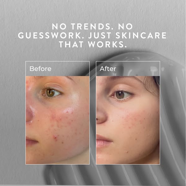 Clear skin in just 90 days