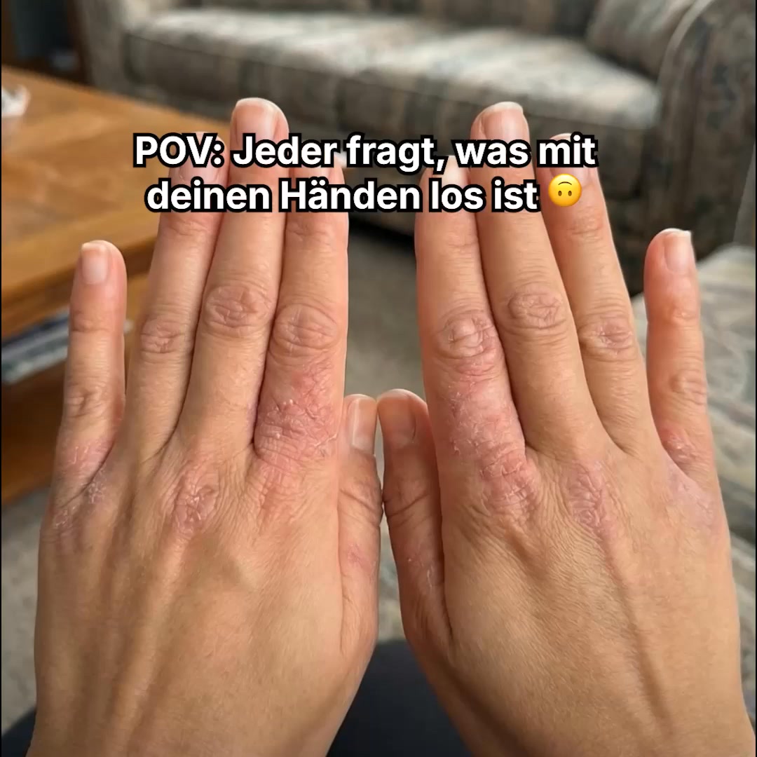 Sofortige Linderung für deine Haut! 💧