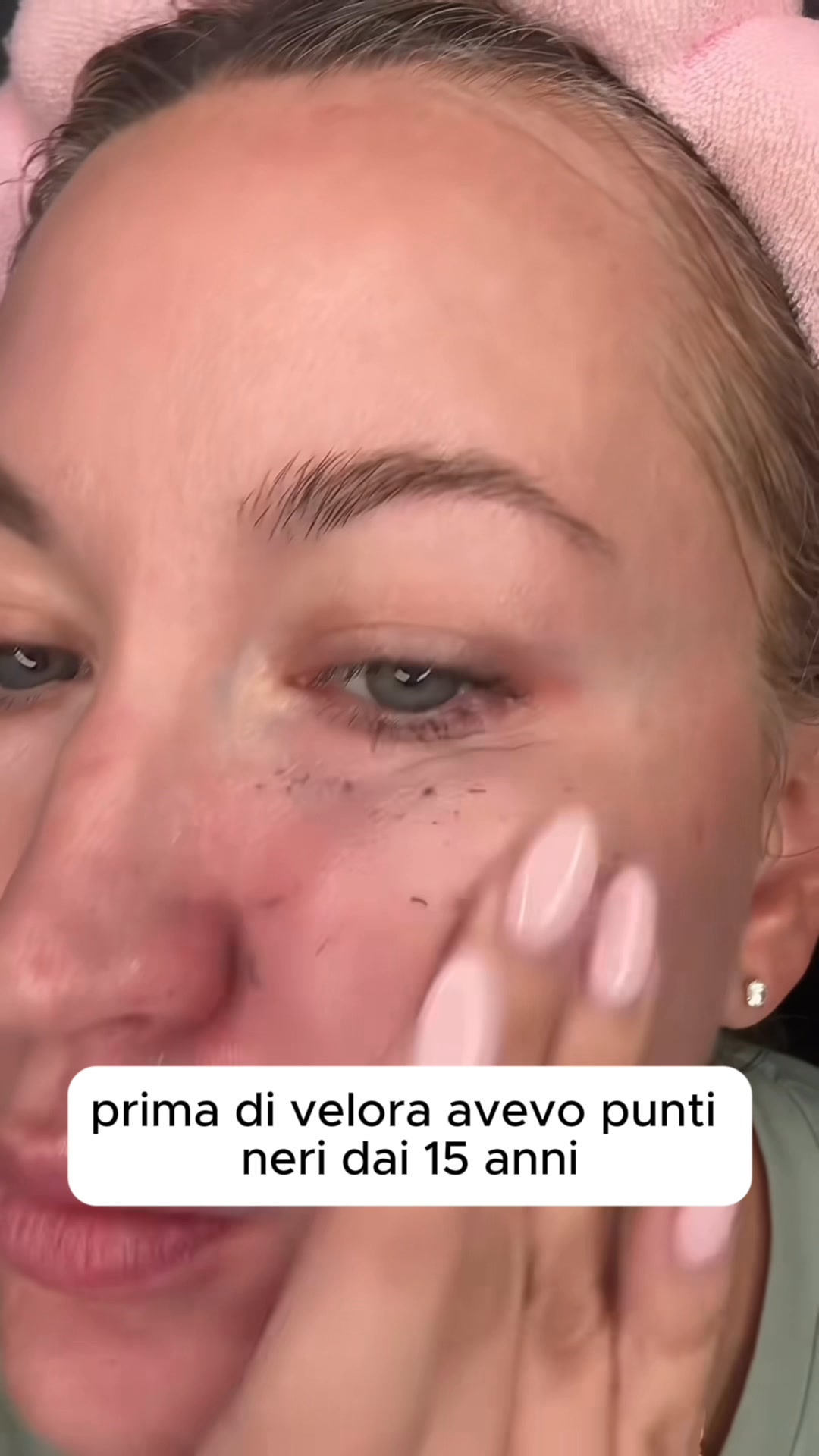 Dì addio ai punti neri