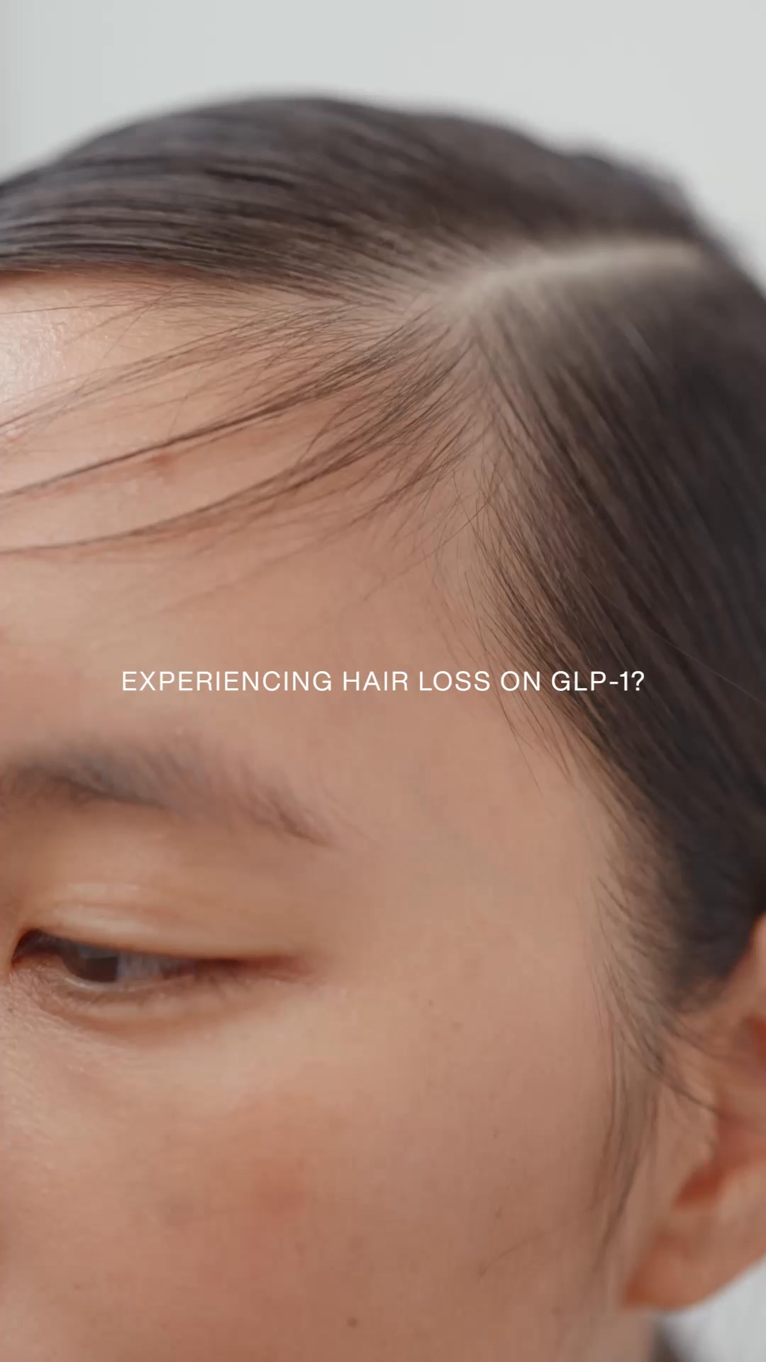 Dealing with GLP-1 Hair Loss?