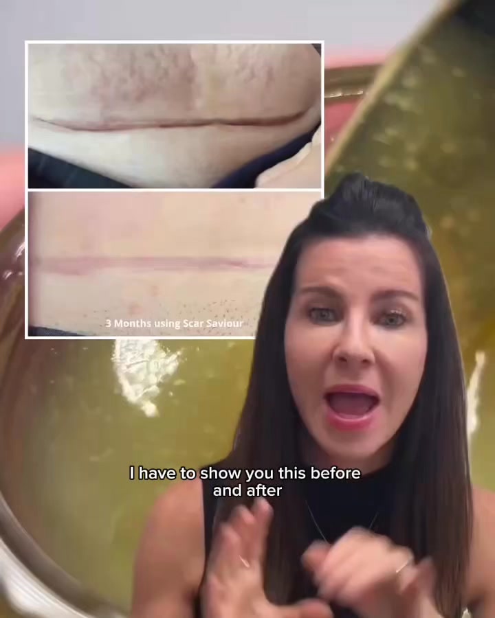 C-section scar recovery balm