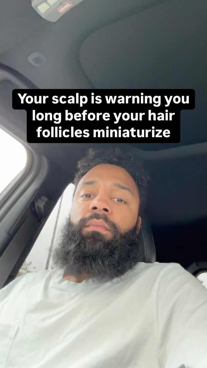 Your scalp is warning you long before hair loss occurs🫣

In order to have healthy hair you must have a healthy scalp. Be mindful of how your scalp is feeling and take care of yourself❤️🌿

Hair loss is caused by Hair Follicle Miniaturization and you can stop it by being proactive‼️

#hairgrowth #allnaturalproducts