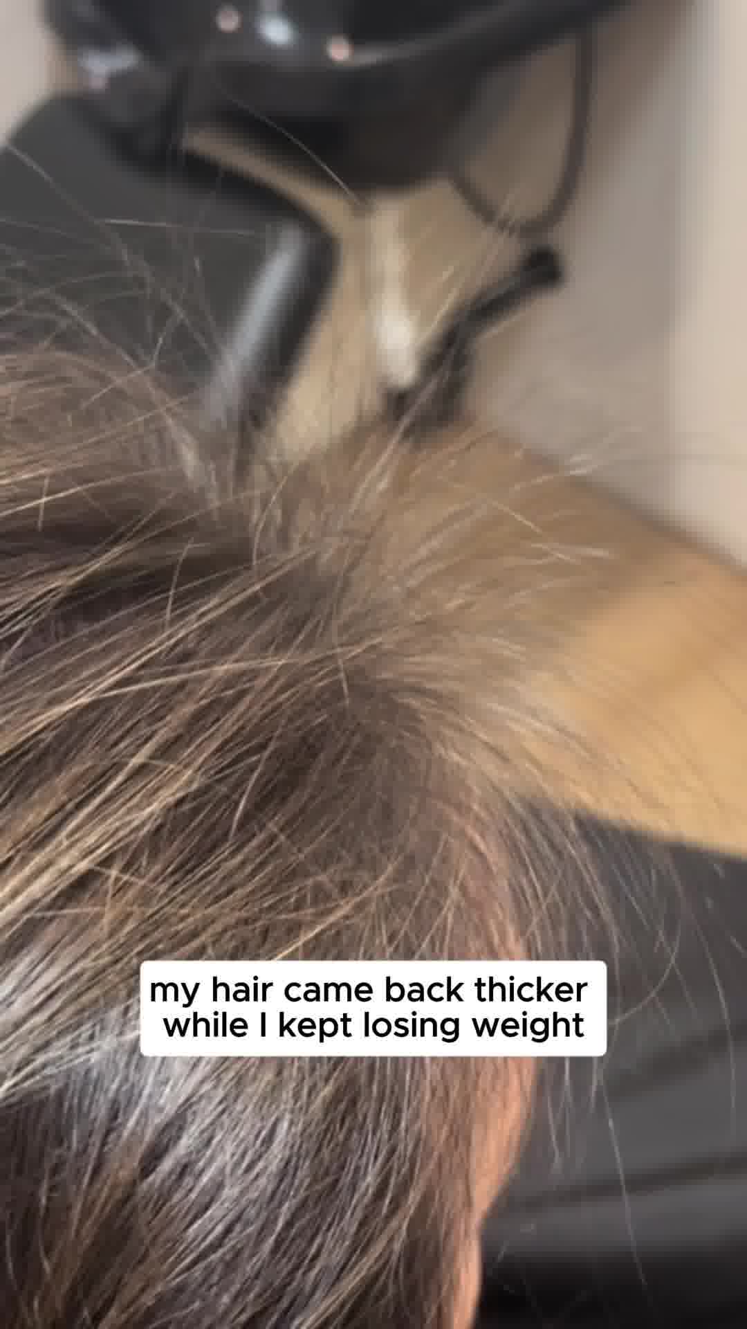 Hair Loss Due to GLP-1