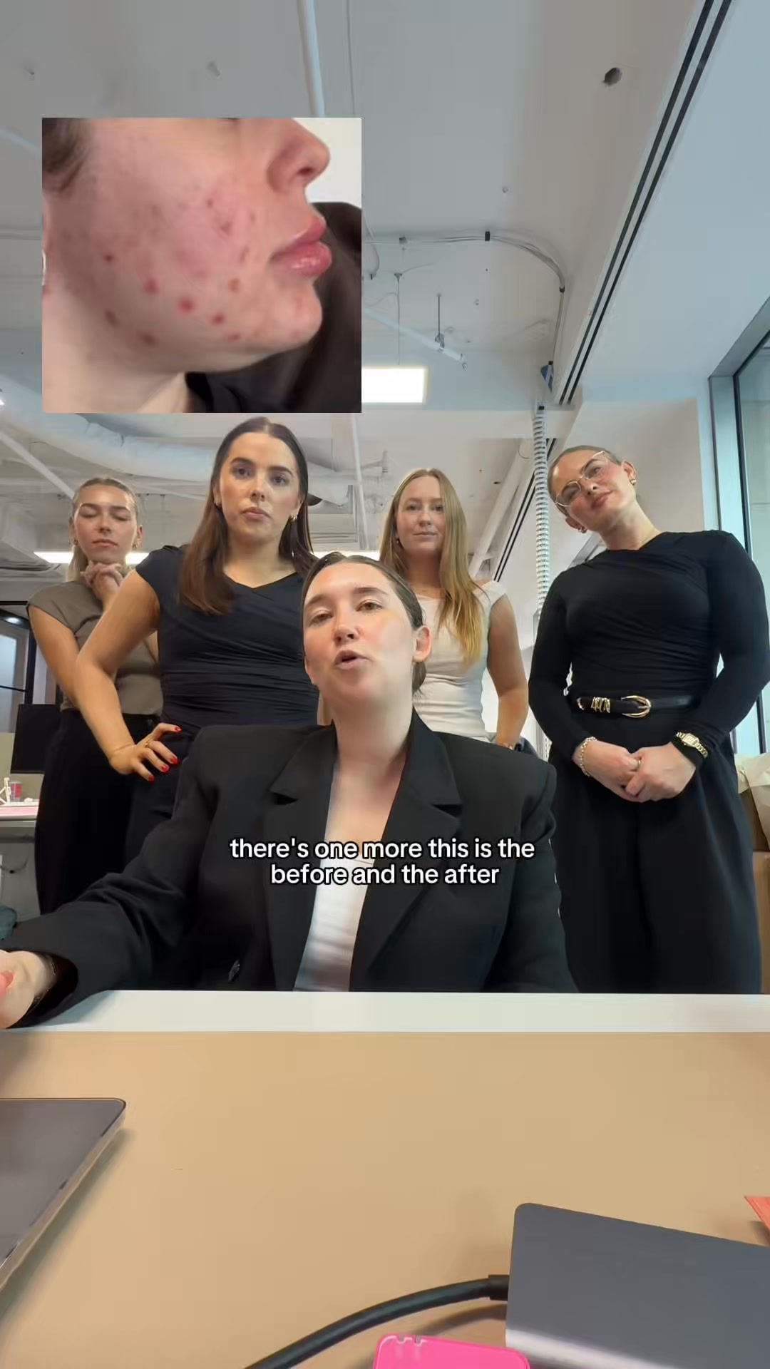 spot cream by the breakout hack