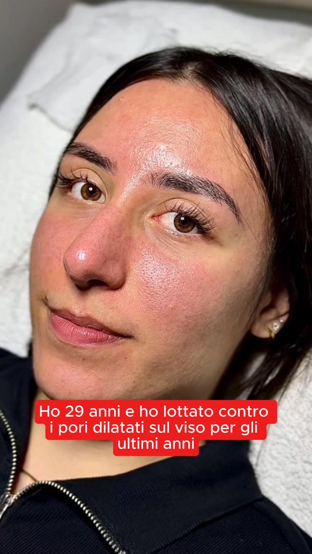 Dì addio ai punti neri