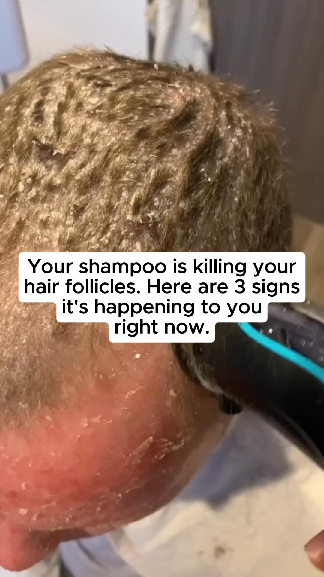 70% OFF – Not Bald, Not Even Balding!