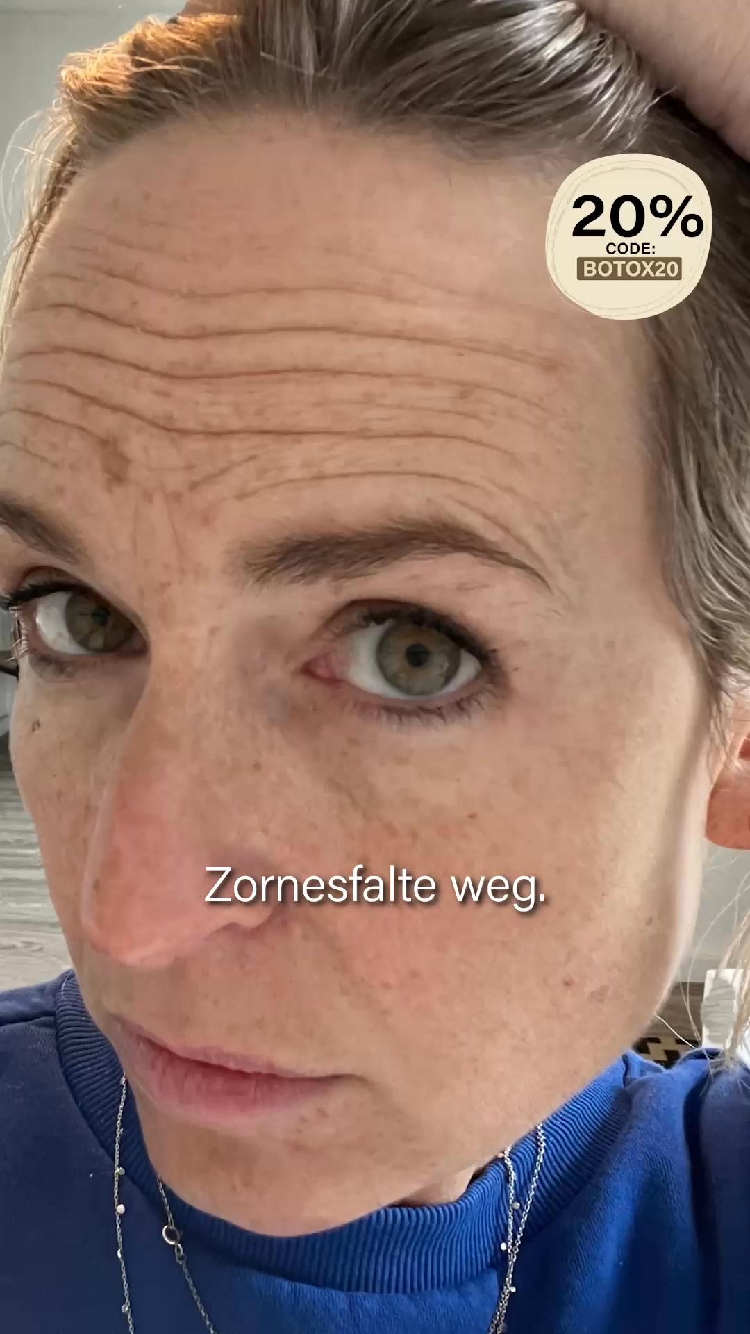 SPARE jetzt 20% mit dem Code BOTOX20 ✨