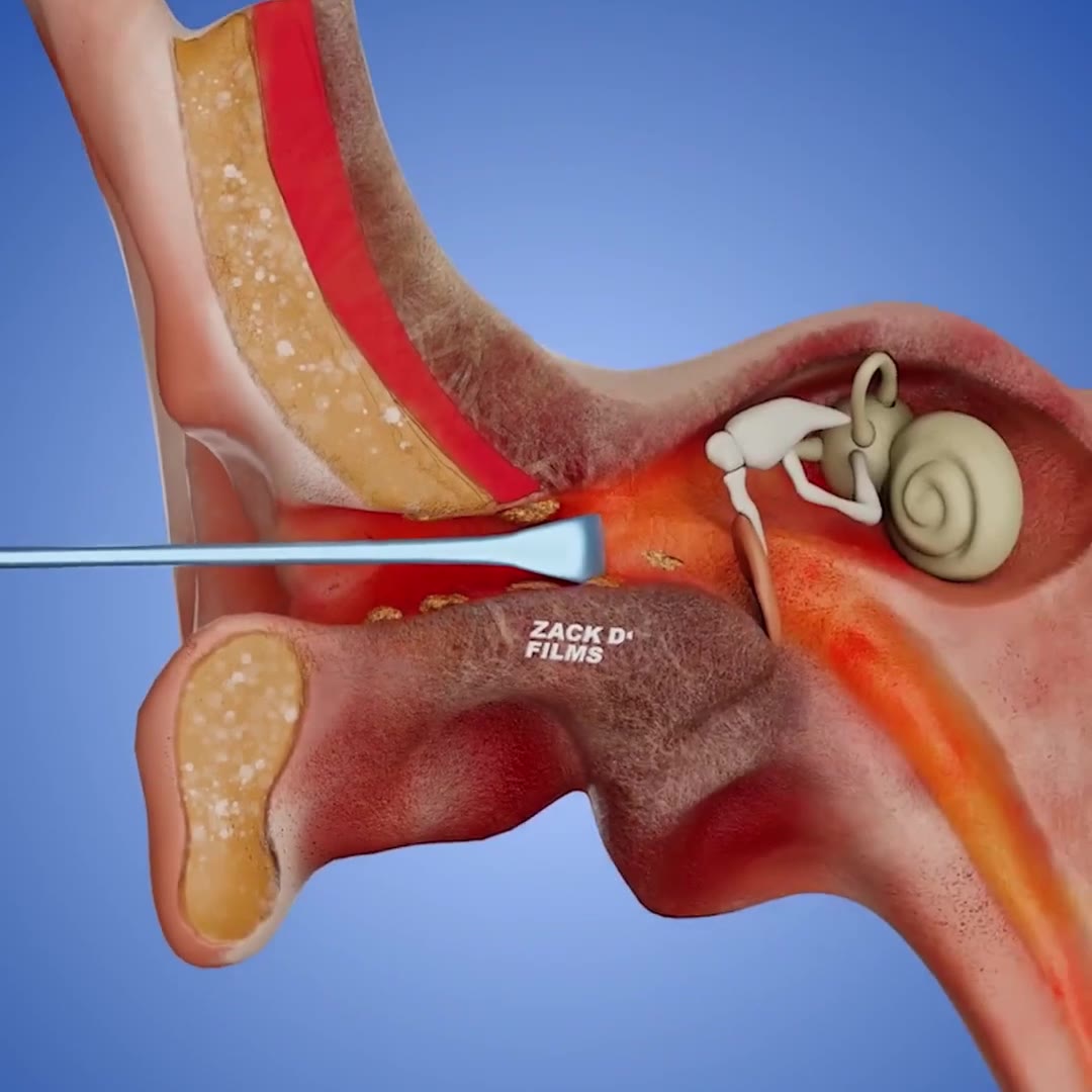 The Smarter, Safer Way to Clean Ears.