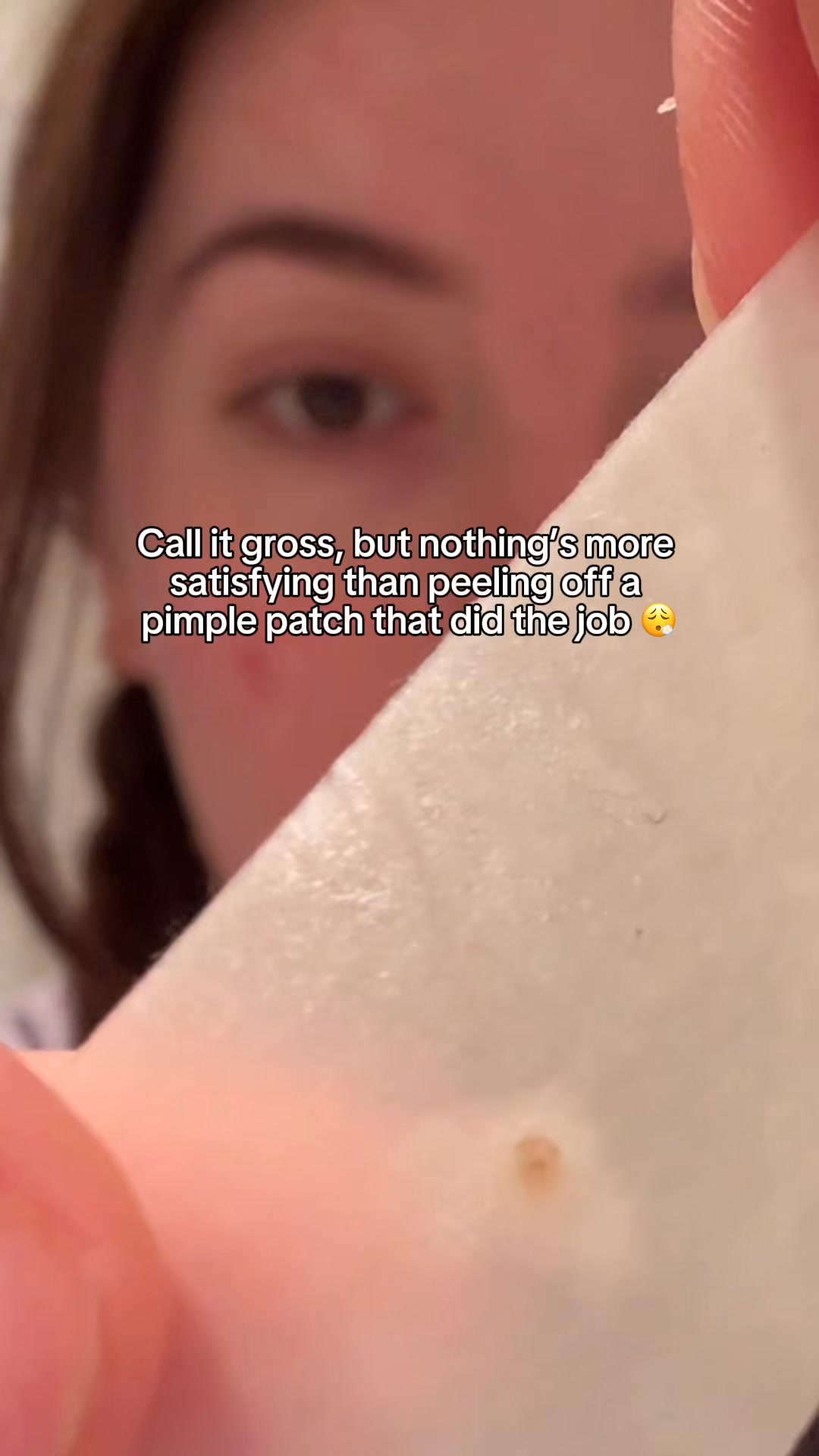 Speeds up recovery of active pimples 🇬🇧