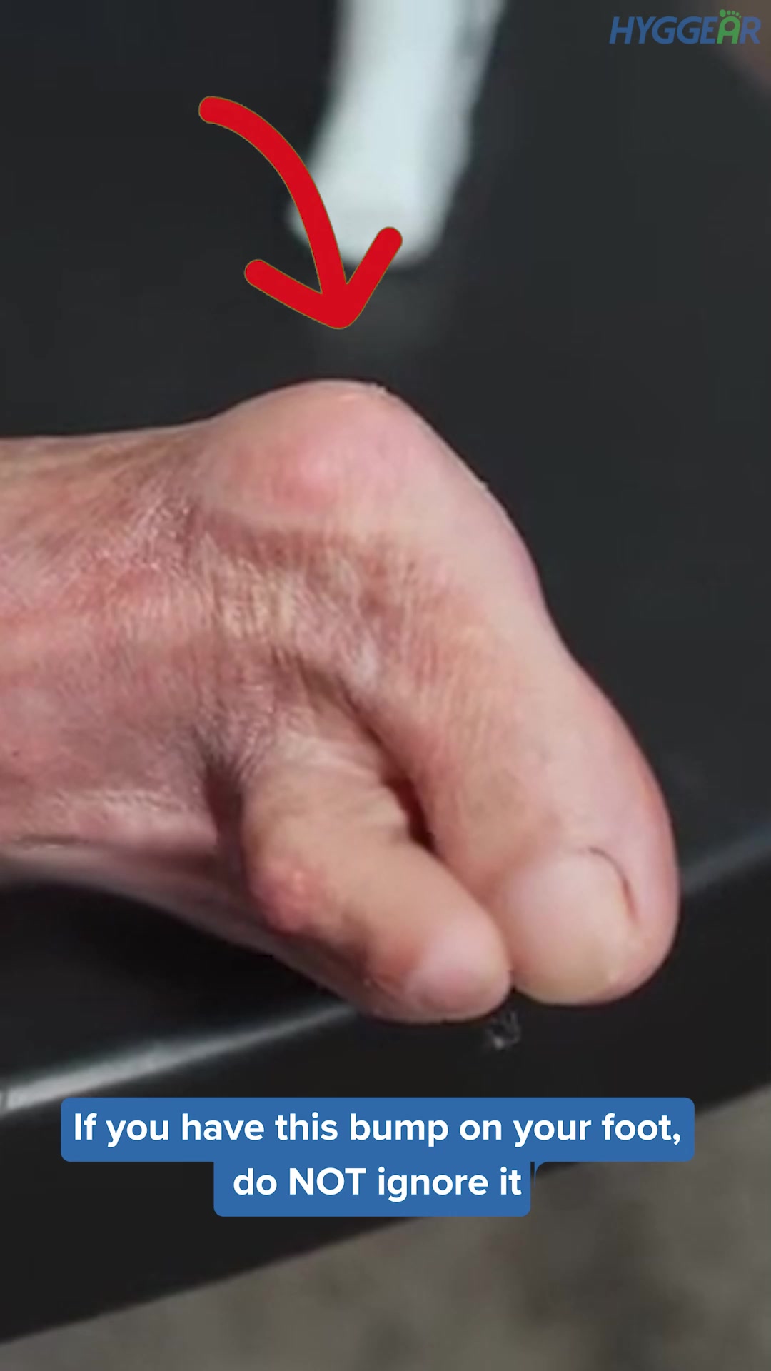 HOW TO GET RID OF FOOT NUMBNESS?