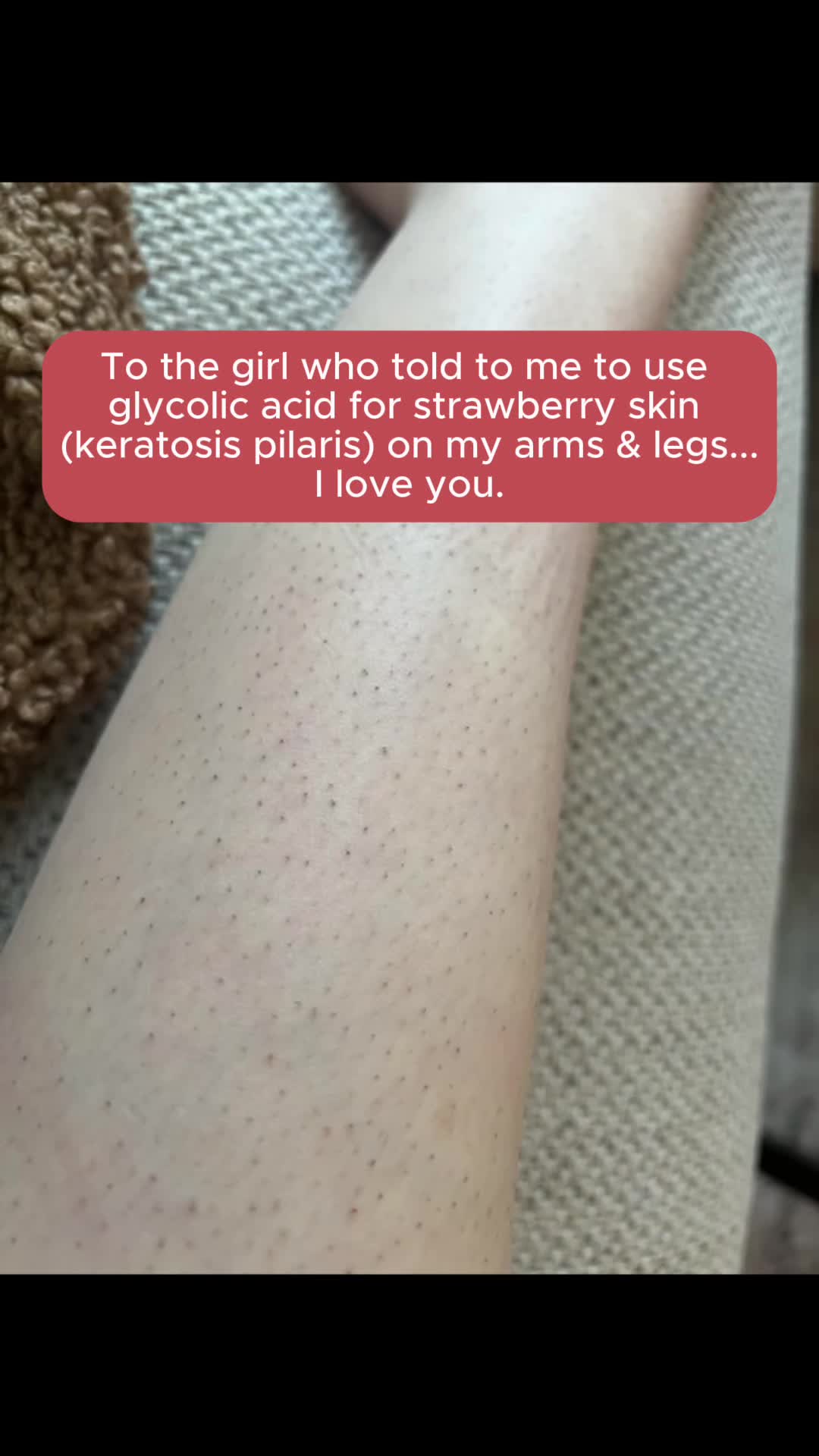 Triple-Acid Complex for KP