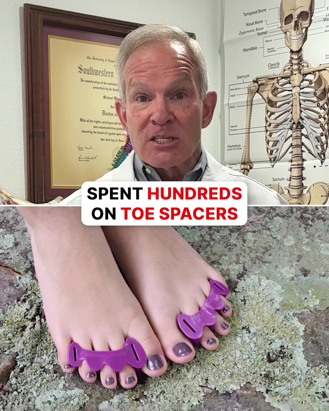 Fix Your Bunions Without Surgery