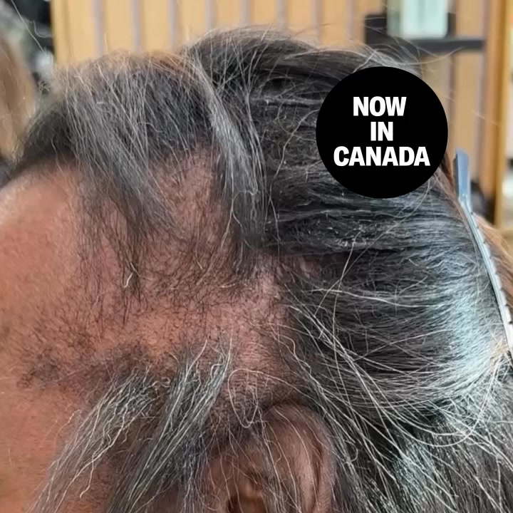 Regrow Your Hair in Weeks