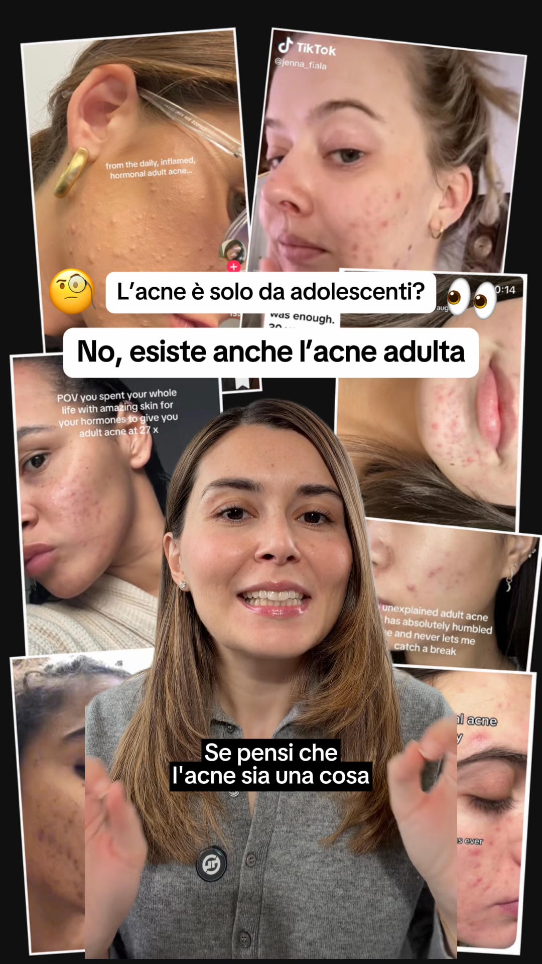 SOS Acne Adulta
