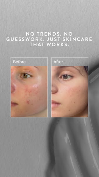 Clear skin in just 90 days