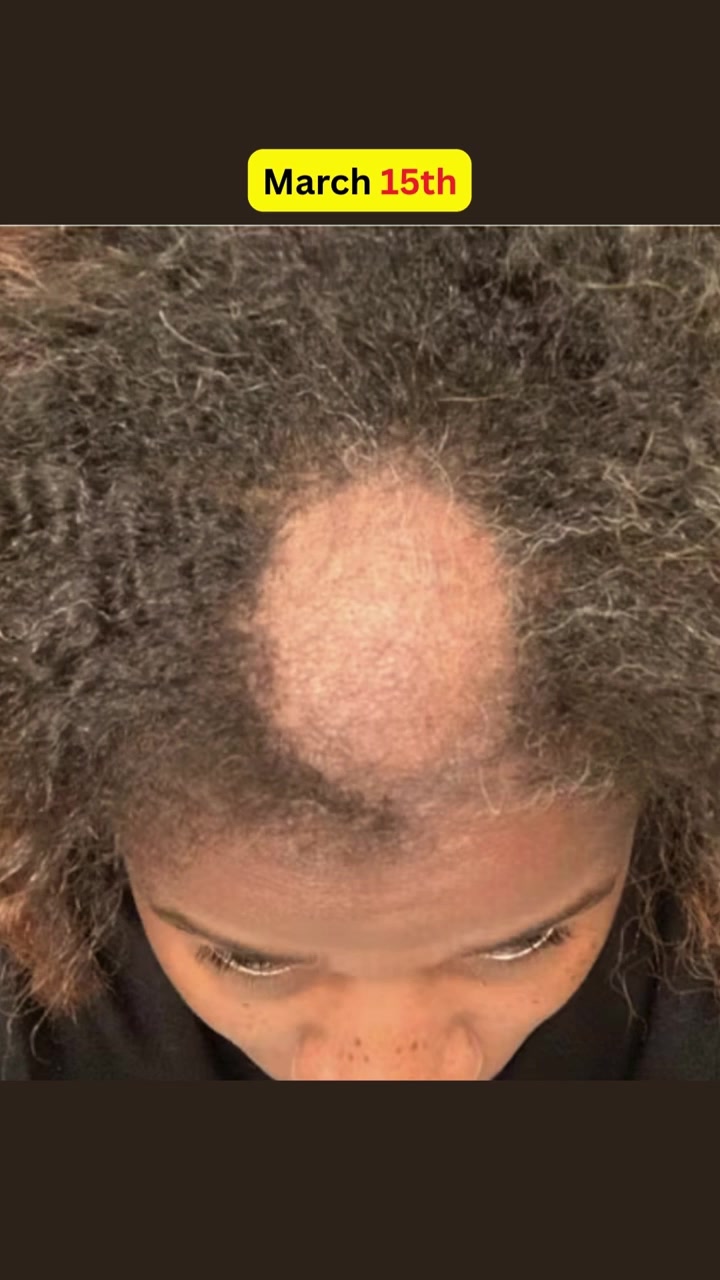 Tired of Watching Your Hair Disappear? This Changes Everything.